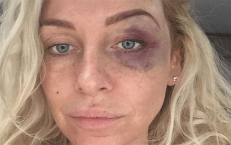 Ex-Big Brother denuncia que sofreu agressão de boxeador