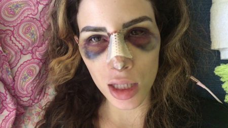 Camilla Uckers anuncia que vai processar médico após complicação cirúrgica