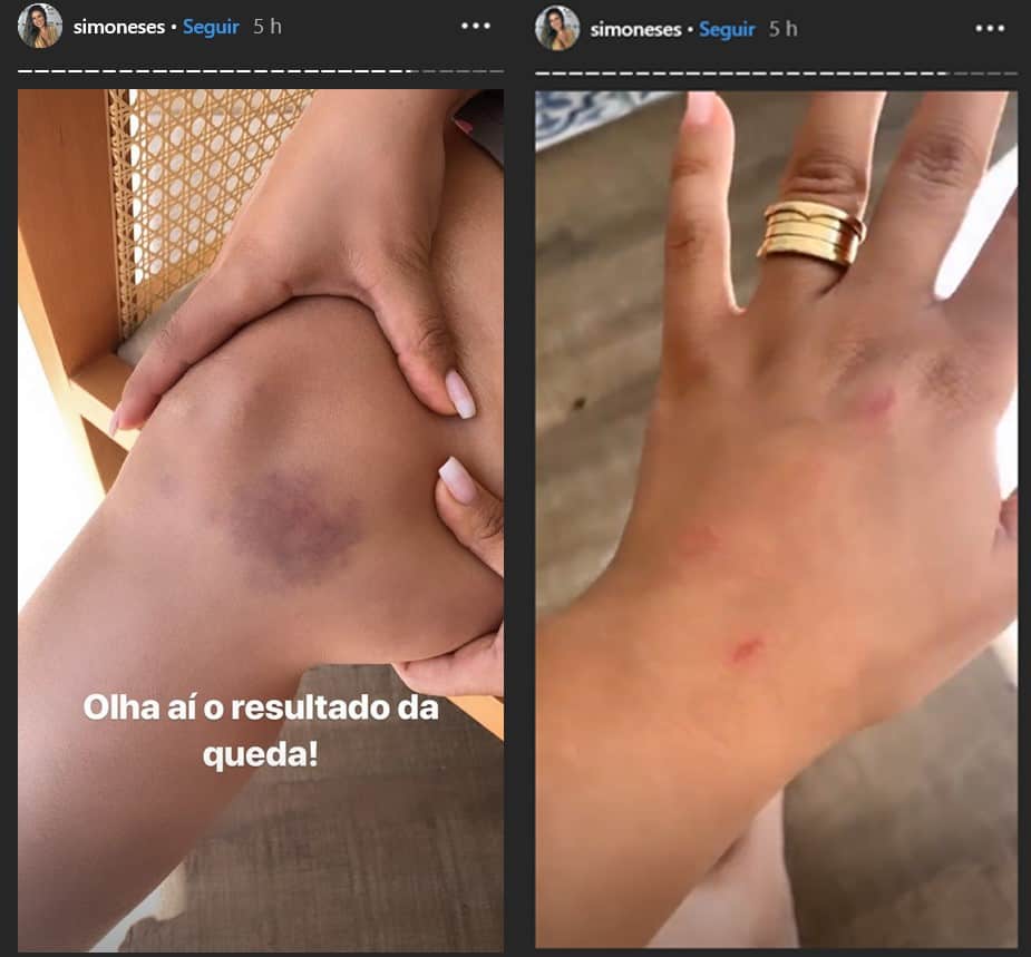 Simone Mendes sofre acidente doméstico e mostra hematomas 