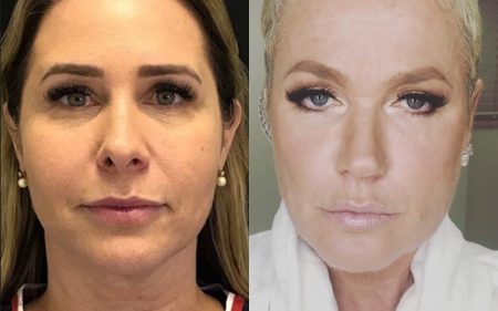 Ex-paquita surpreende Xuxa com resultado final da harmonização facial