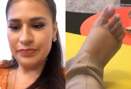 Simone Mendes surge com pé inchado e explica motivo