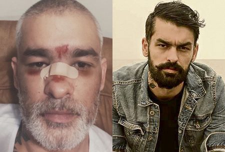 Ex-músico do Fresno sofre grave acidente e aparece com rosto fraturado
