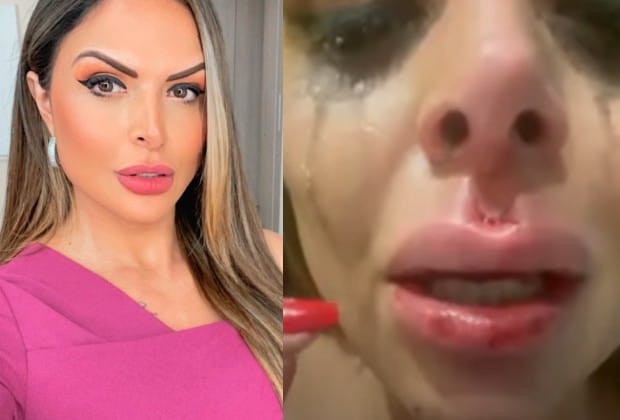 Apresentadora da Record gasta R$ 20 mil para operar o rosto após ser agredida pelo ex