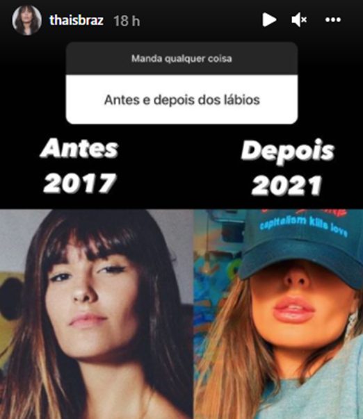 Thais Braz mostra antes e depois de preenchimento labial