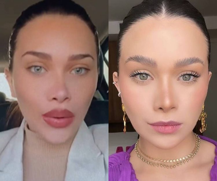 Flávia Pavanelli mostra antes e depois de procedimento estético