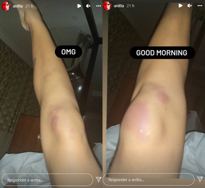 Anitta mostra hematomas no corpo após festa de aniversário