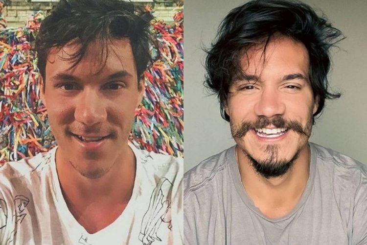 Eliezer antes e depois da harmonização facial