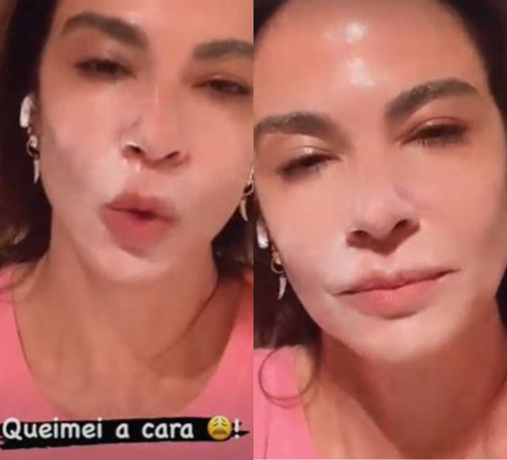 Luciana Gimenez aparece com o rosto queimado e explica o que aconteceu