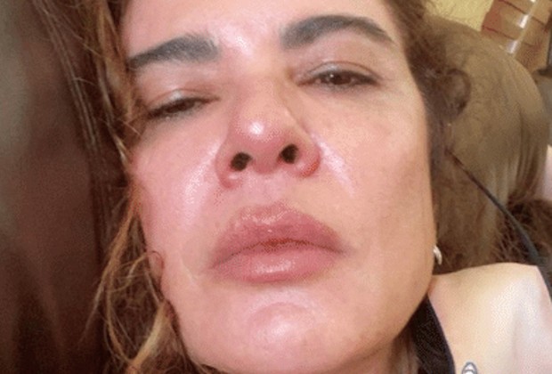 Luciana Gimenez relata dores intensas após acidente: “Não passa”
