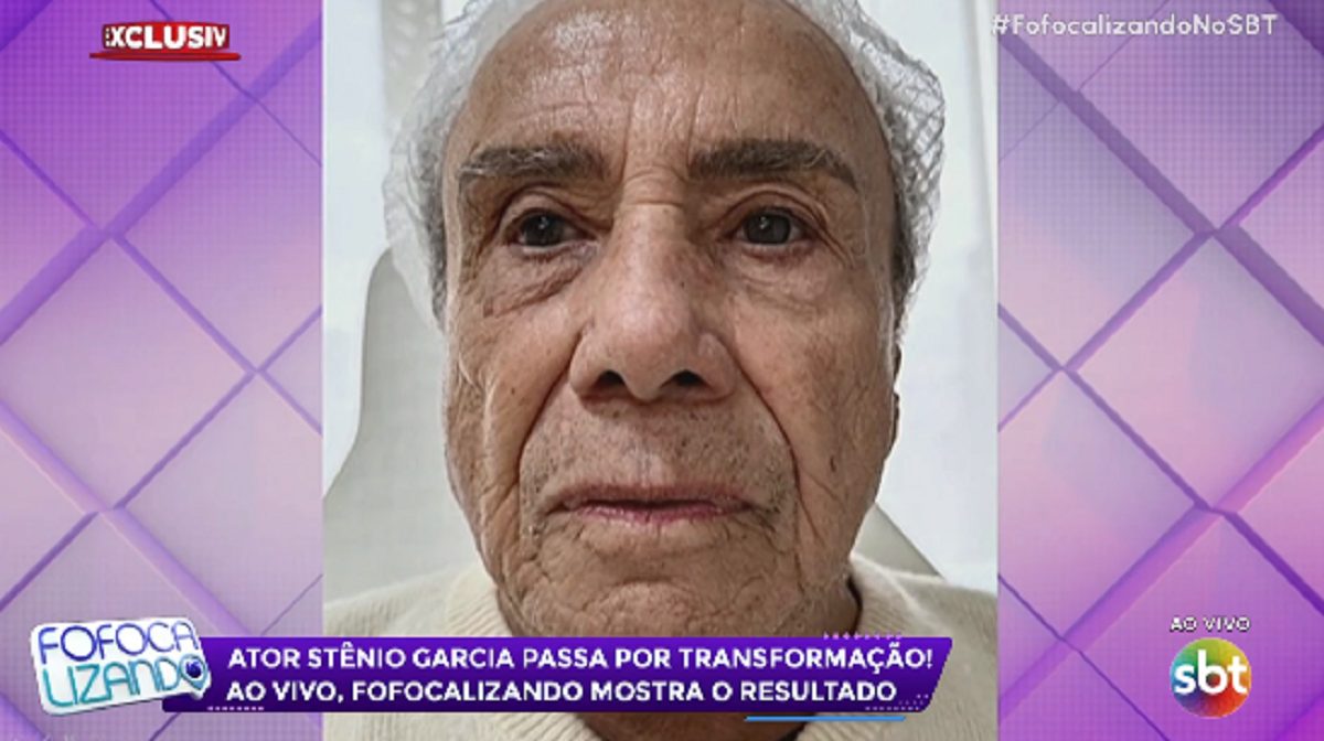 Stenio Garcia passa por harmonização facial e choca público do Fofocalizando: “É cilada!”