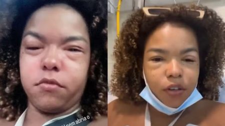 Jeniffer Nascimento surge com o rosto deformado e motivo vem à tona
