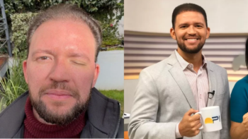 Apresentador famoso aplica botox e exibe complicações após procedimento